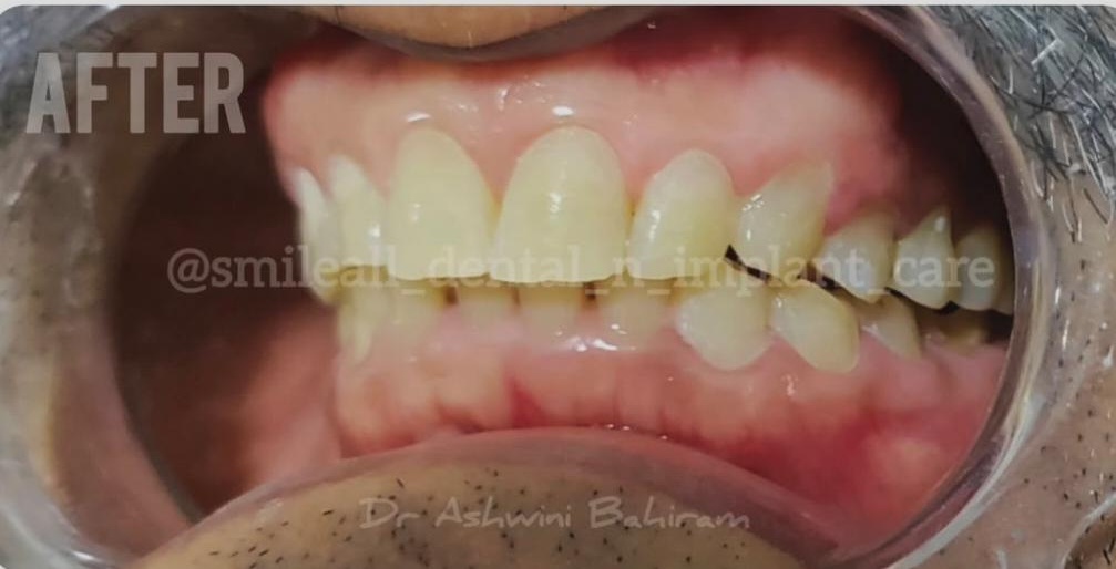 After teeth whitening